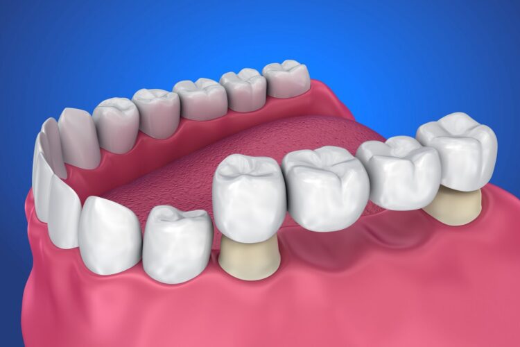 Fixed Dental Bridge