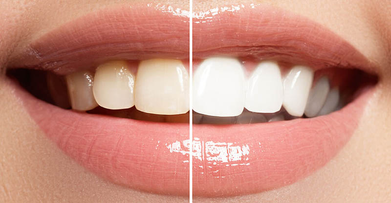 Teeth Whitening San Francisco